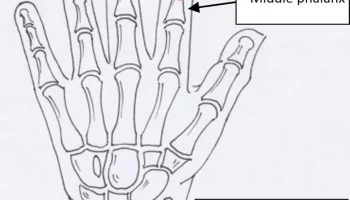 Протез пальца BioMech (указатель левой руки)......... 3